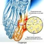 http://medicinemoscow.ru/uploads/images/doktor/terapevt/podagra.jpg